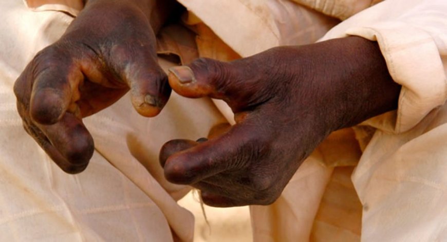 Ghana Observes World Leprosy Day, Highlights Need to End Stigma
